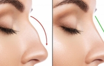 Uygun Fiyatlarla Muhteşem Bir Buruna Sahip Olun