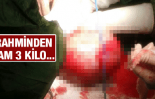 RAHMİNDEN TAM 3 KİLO MYOM ÇIKARILDI!