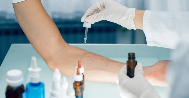 Alerji Testi ile Şikayetlerinizden Kurtulun