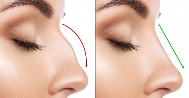 Uygun Fiyatlarla Muhteşem Bir Buruna Sahip Olun